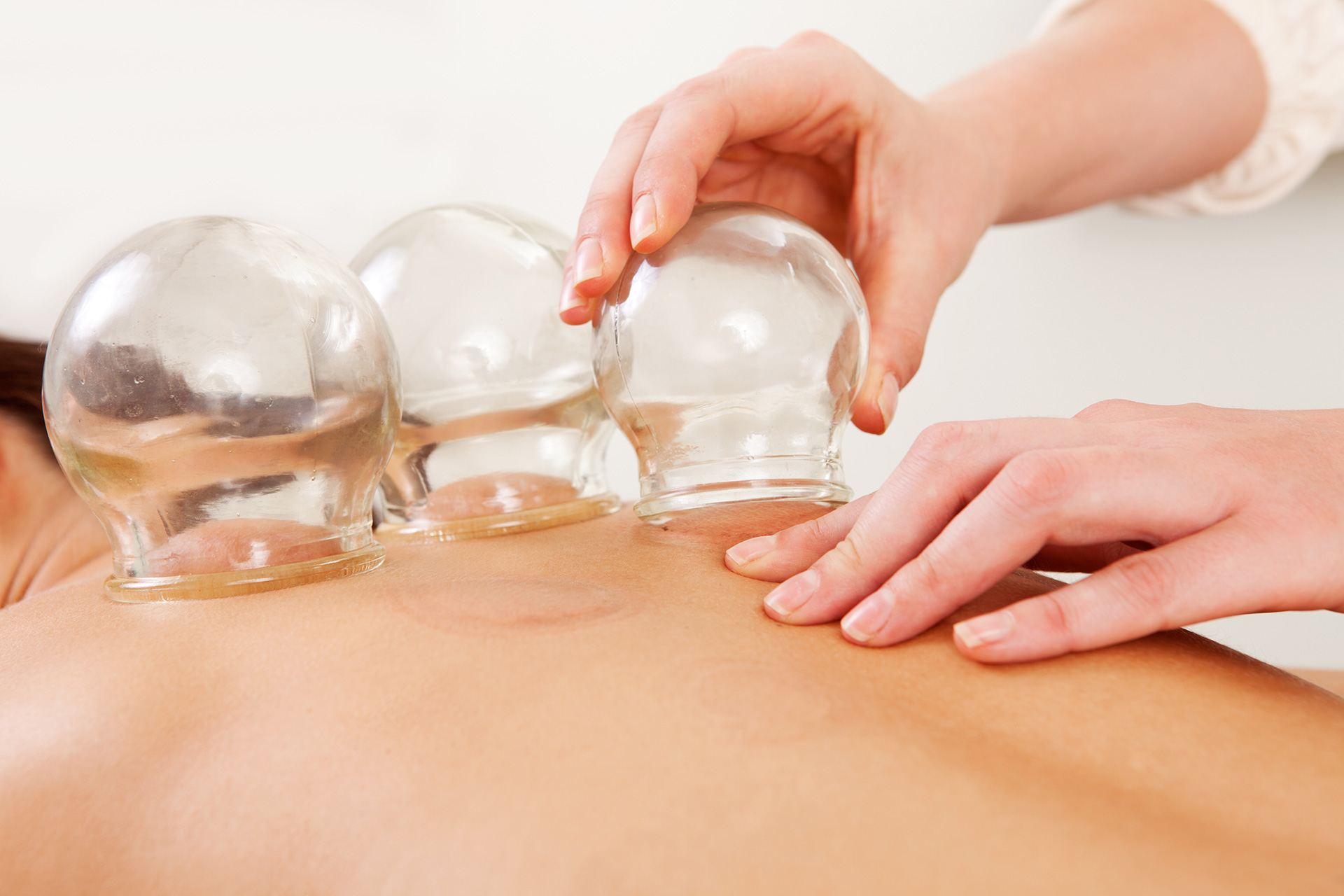 Cupping Therapy at Evergreen Medical Acupuncture