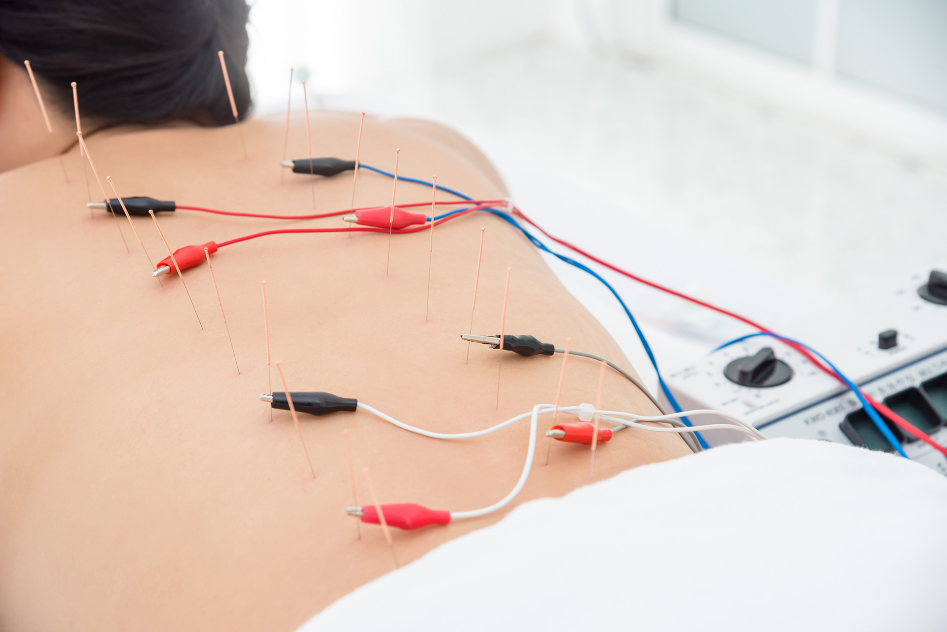 Electric Dry Needling at Evergreen Medical Acupuncture