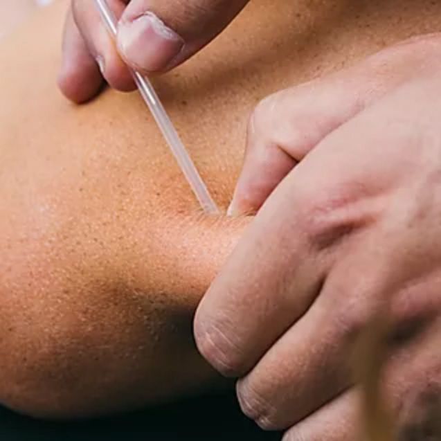 Electric Dry Needling at Evergreen Medical Acupuncture