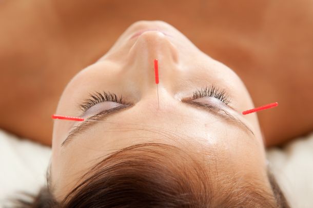 cosmetic-acupuncture