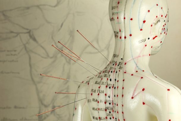 medical-acupuncture