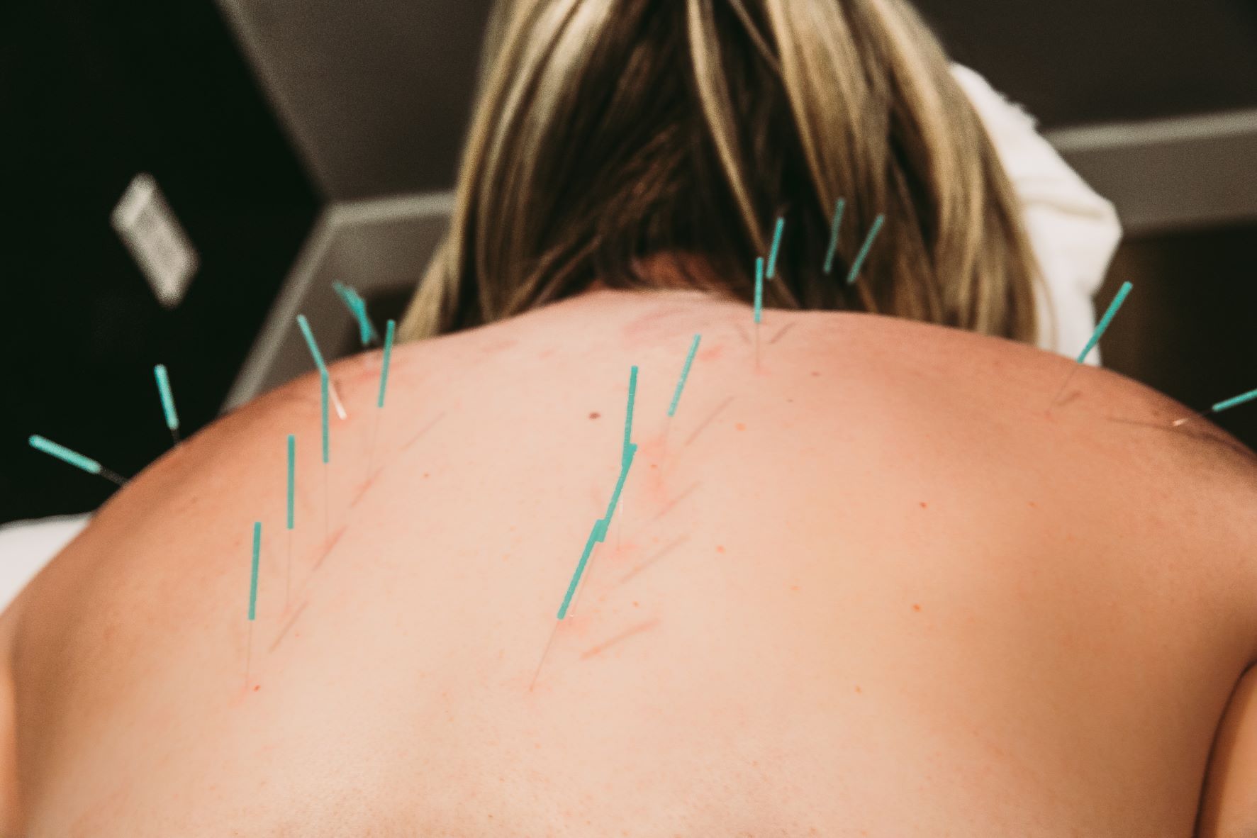 A, Traditional acupuncture: manual manipulation of an inserted needle